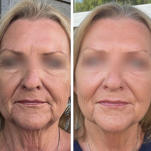 Casey review and results from using Tranont Glow Collagen