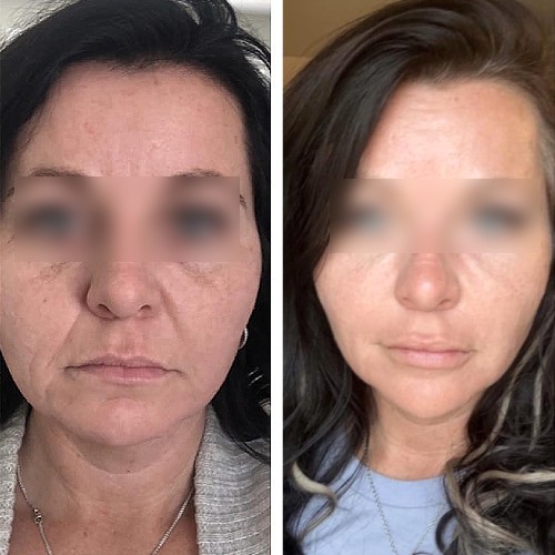 Steph review of Glow Collagen - before and after